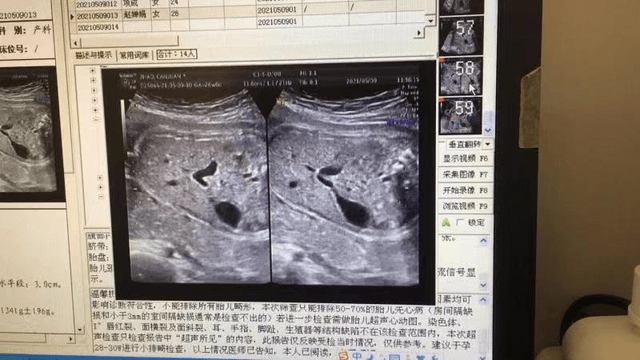 胎儿十二指肠闭锁声像图