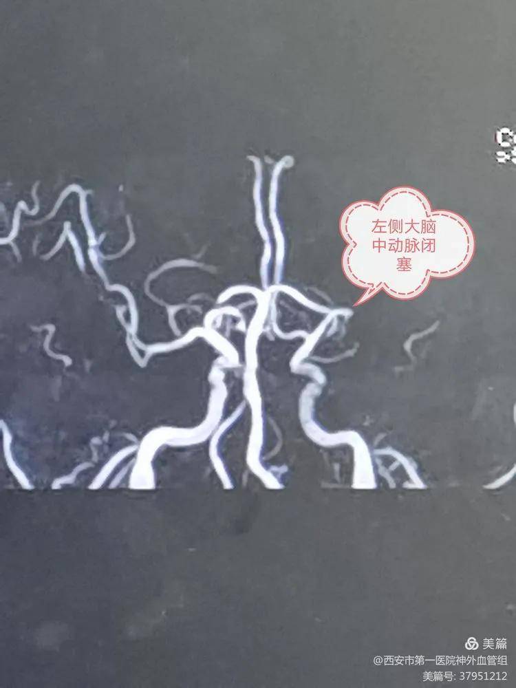 核磁血管成像提示左侧大脑中动脉闭塞!