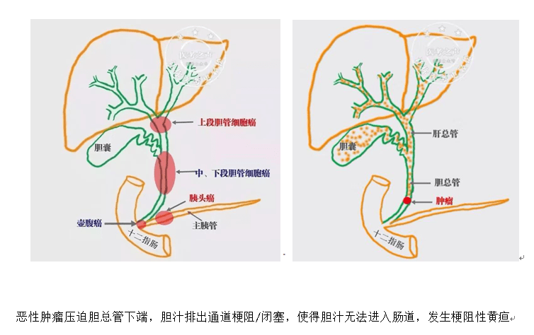 苏州高新区人民医院为高龄老人实施胆道支架再建生命通道