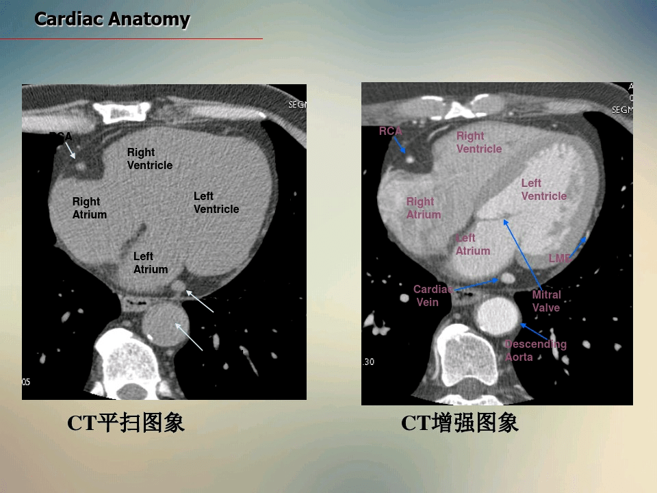 心脏ct断面解剖