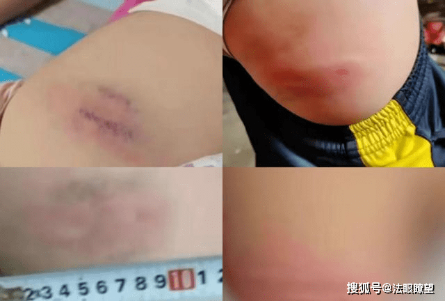 山东54名小学生遭教师体罚:棍子打断成三截,屁股肿得不能碰