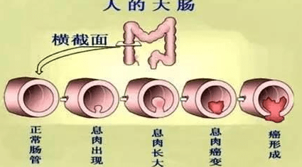 90%左右肠癌由肠息肉病变引起?预防息肉就是预防肠癌