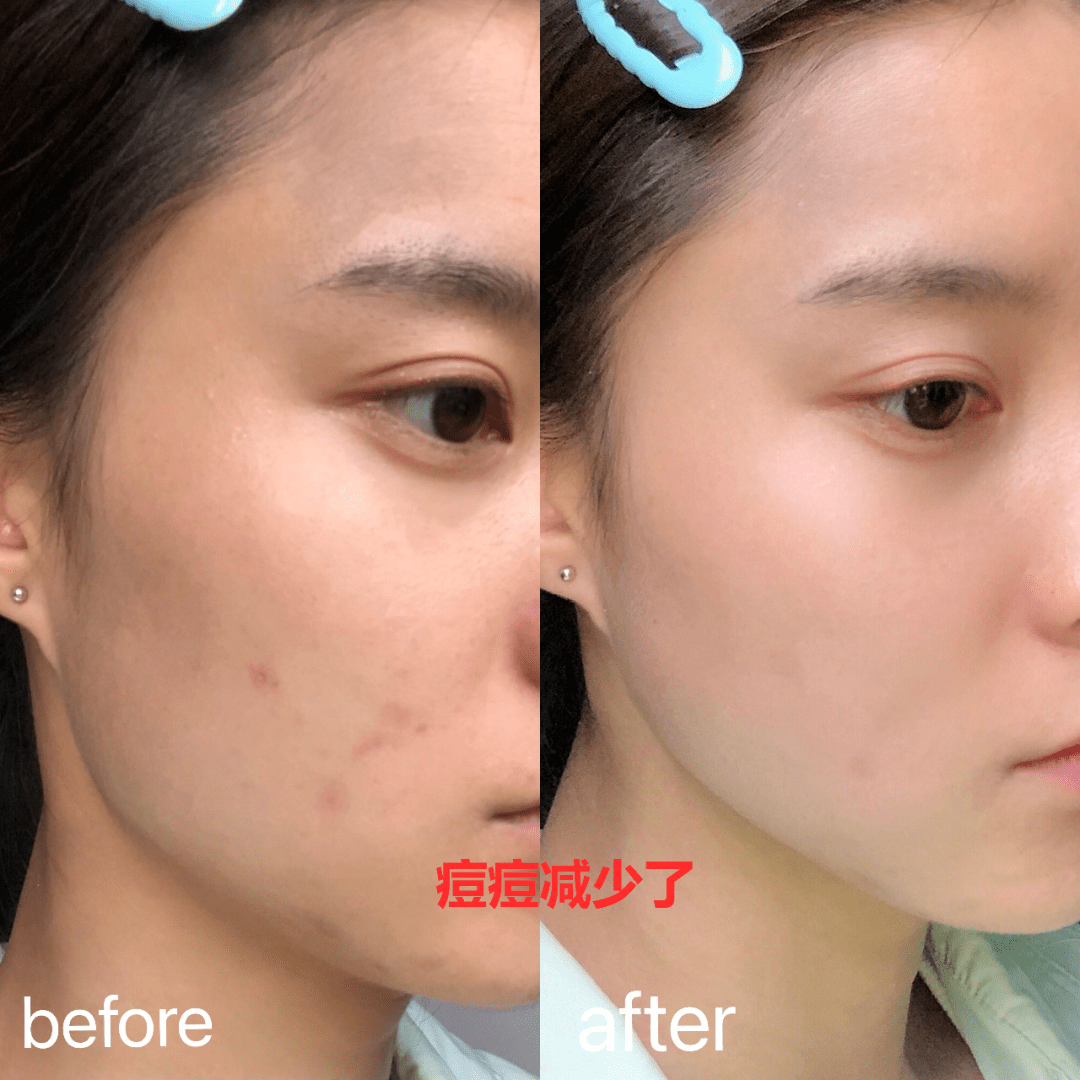 原创夏季皮肤油腻又长痘?记住这个方法,科学又省钱!
