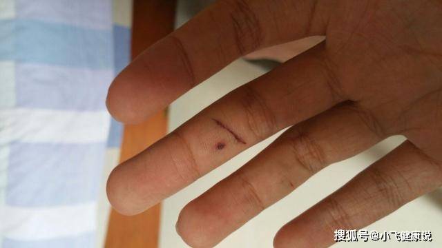 关于破伤风的3个误区你知道吗不清楚的不妨看看