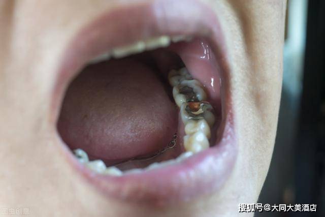 牙齿残根不要轻易拔掉说不定可以起到大作用