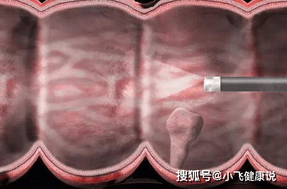 大便出现这个信号的时候,请勿忽视,有可能是大肠癌已经来了