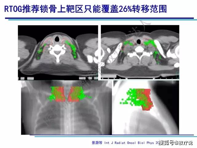 课件分享 | 王淑莲教授:乳腺癌改良根治术后的放疗原则与靶区勾画范围