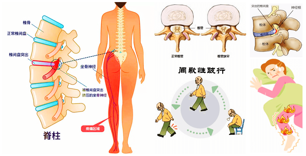 脊柱科普丨腿痛?可能是腰出现了问题!_腰椎间盘