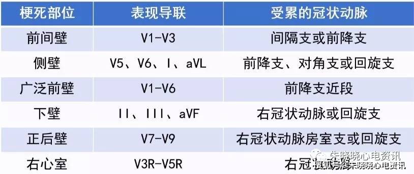 表1. 心电图导联与冠脉血管对应关系