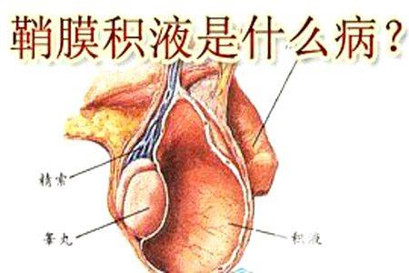 鞘膜积液是怎么回事关于小儿鞘膜积液的若干问题