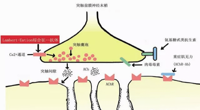 重症肌无力没办法治疗了?不要被它吓到了,它只是在虚张声势而已