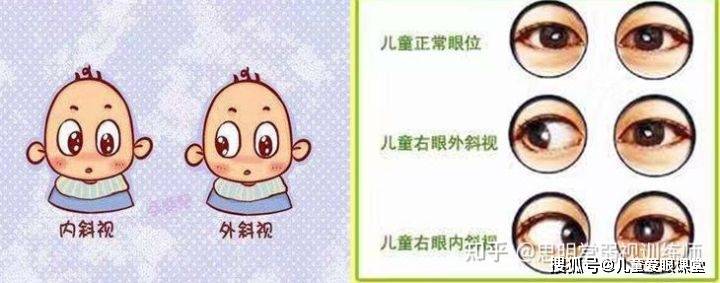 儿童斜视怎么办?