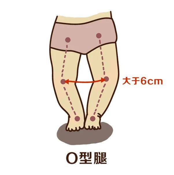 如果双脚脚踝之间距离大于6厘米,则是x型腿.