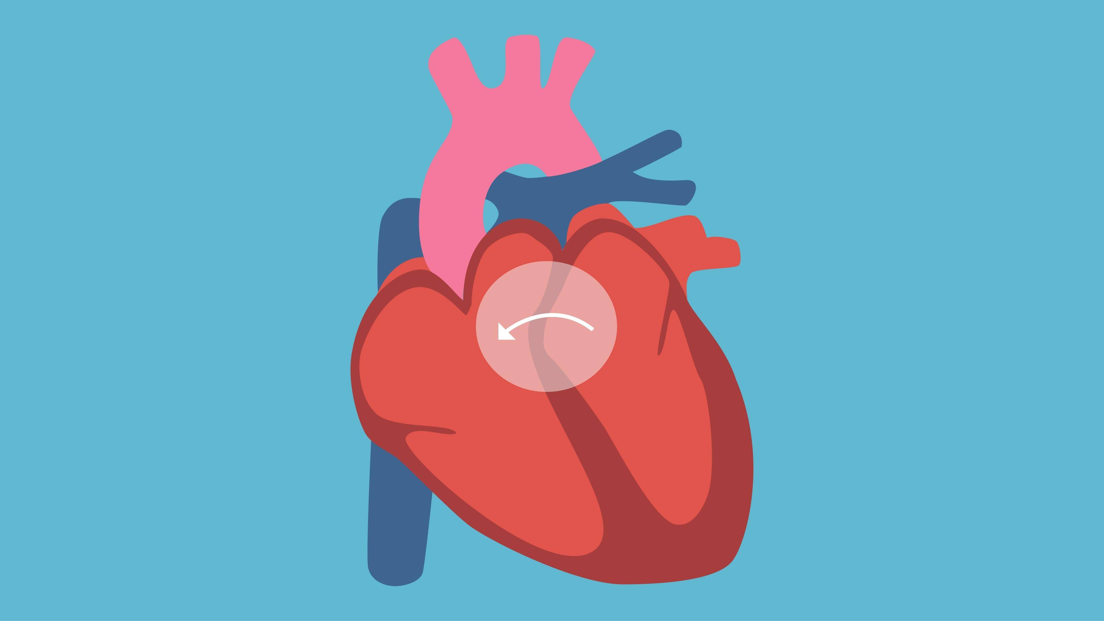 这3种情况,做心脏支架手术是最佳选择,支架真的可以延长寿命吗
