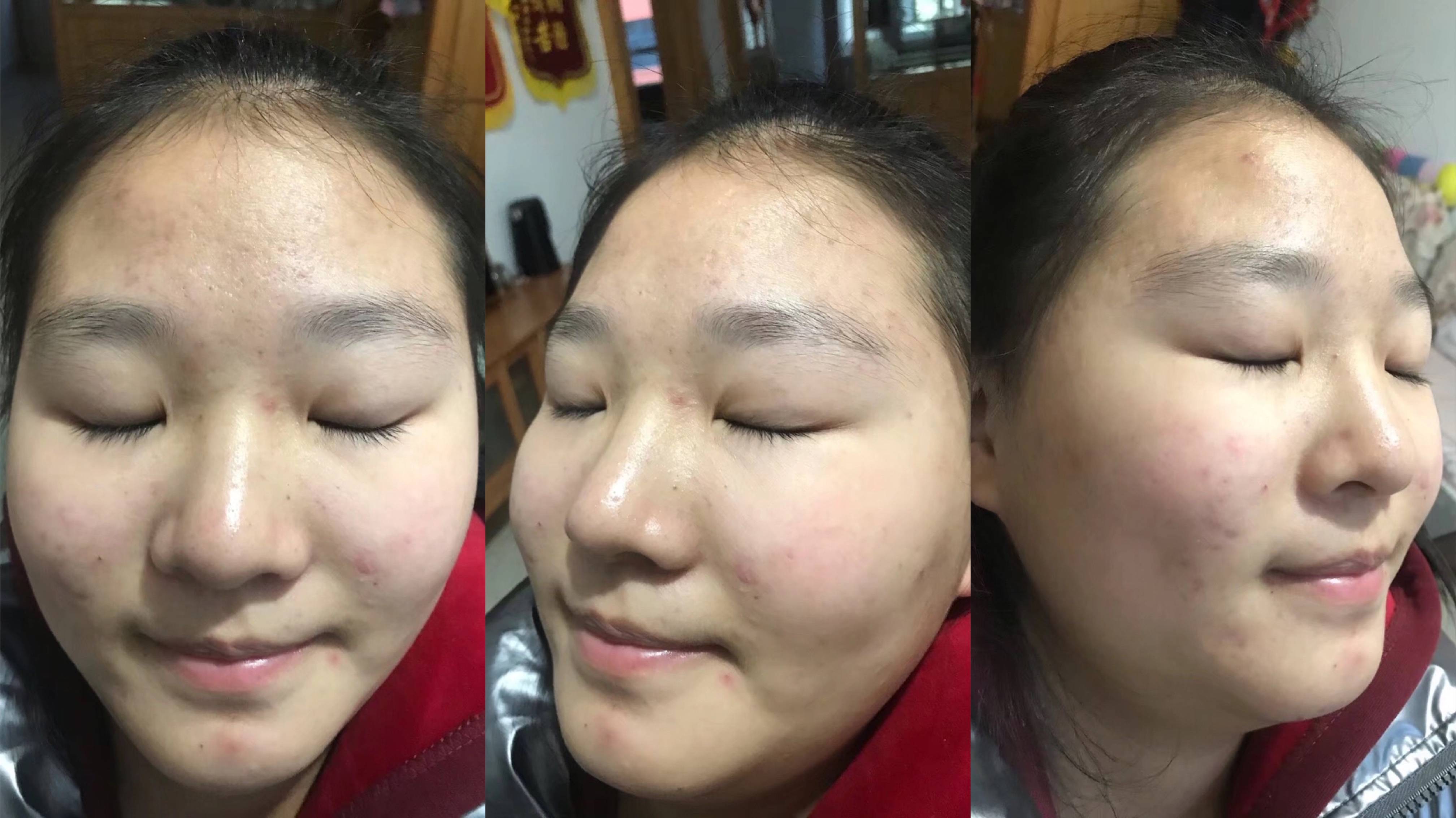 痤疮怎么去除最有效?一个小验方轻松搞定