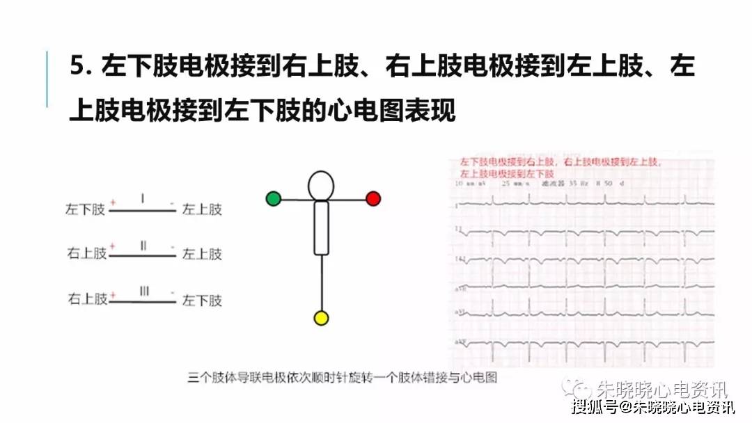 肢体导联电极错接心电图分析及鉴别ppt