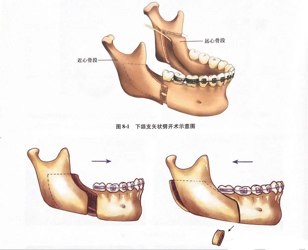 什么是下颌矢状骨劈开shu?