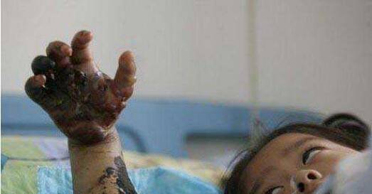 陕西21岁女孩网购银环蛇当宠物被咬送医, 医院宣布已脑死亡.