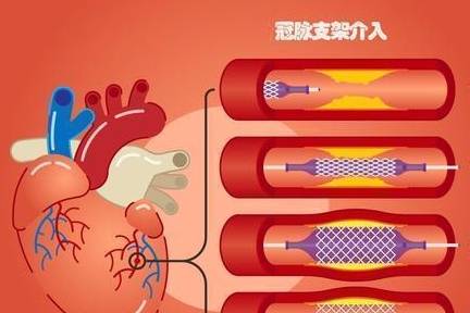 原创装上心脏支架活不过10年?有人术后15年却越活越健康,秘密公开了