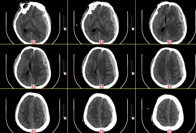 患者ct提示:左侧额颞顶枕部硬膜下出血并脑疝形成;蛛网膜下腔出血