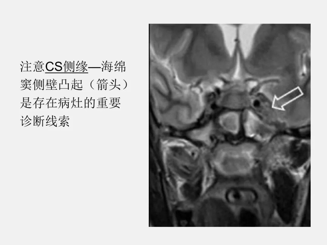 详细的海绵窦疾病总结