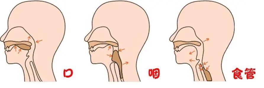 瑞合康复 | 脑卒中后吞咽障碍怎么办?看看小张的进食之路!