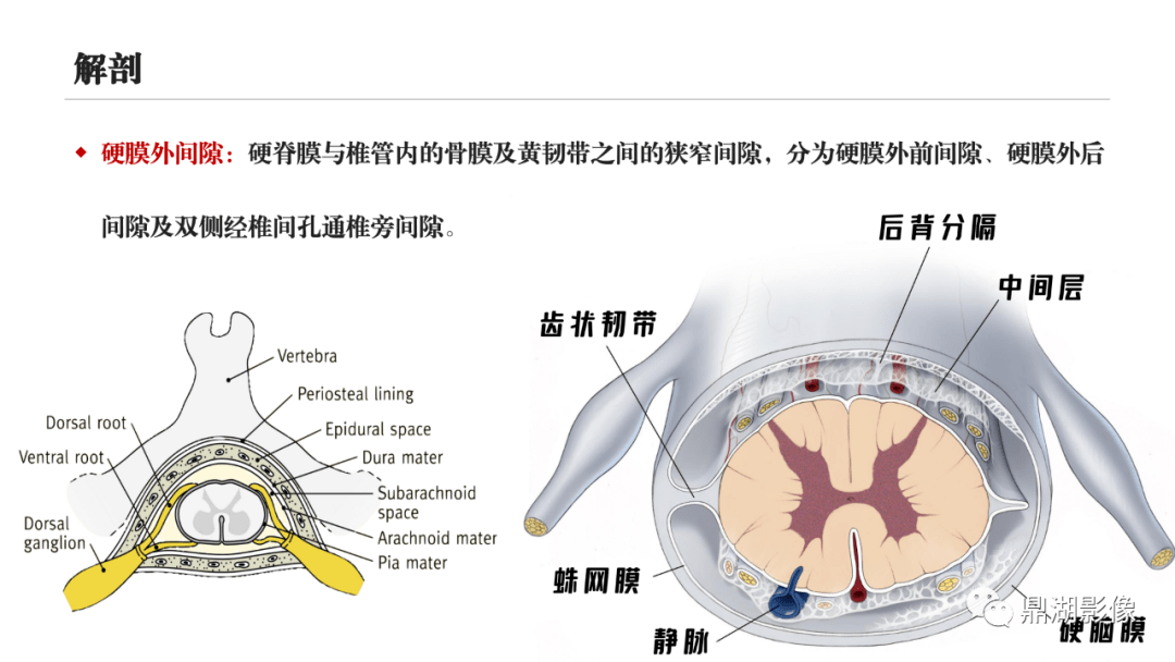 椎管内硬膜外脂肪增多症