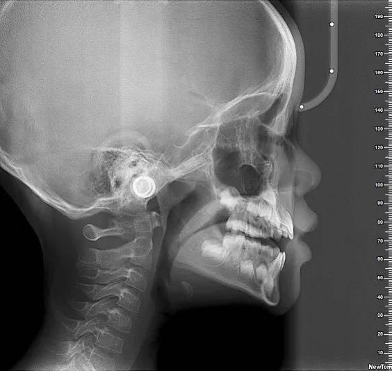 拍摄全景x光片与头颅侧位片不仅仅可以发现蛀牙,检查牙周骨骼,例如在