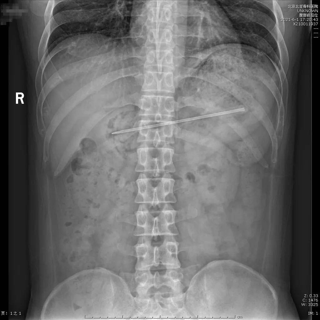 17cm长毛衣针胃内留存7个月,北亚消化科内镜下顺利取出!