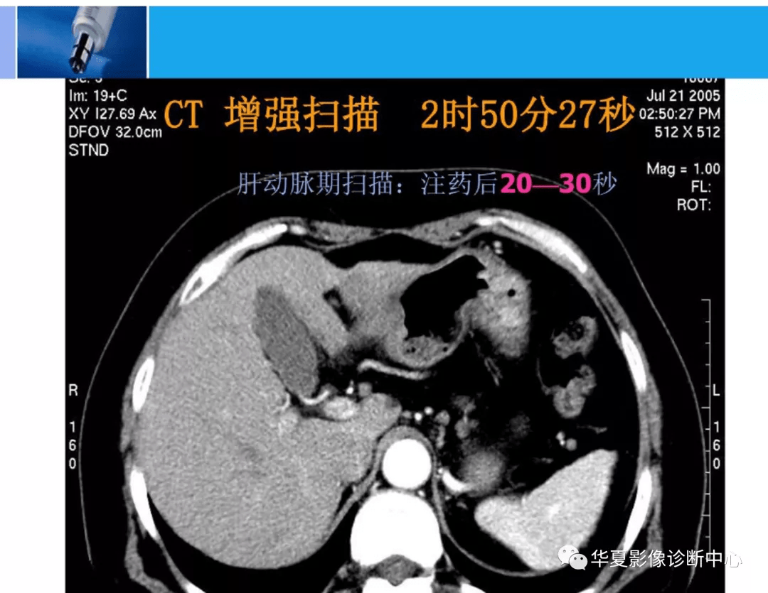 精华全篇:肝脏的ct影像诊断