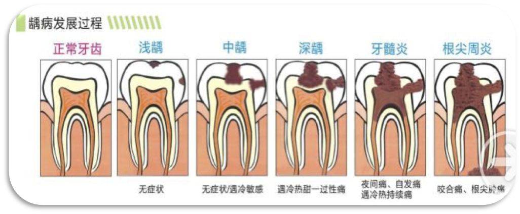 龋病发展过程龋病的发生有一个较长的过程,从初期龋到临床形成龋洞