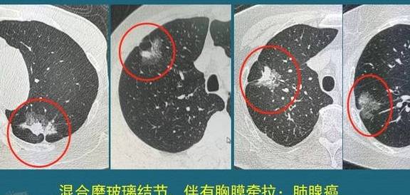 原创肺腺癌是怎么长出来的?医生介绍3种肺结节,一学就会