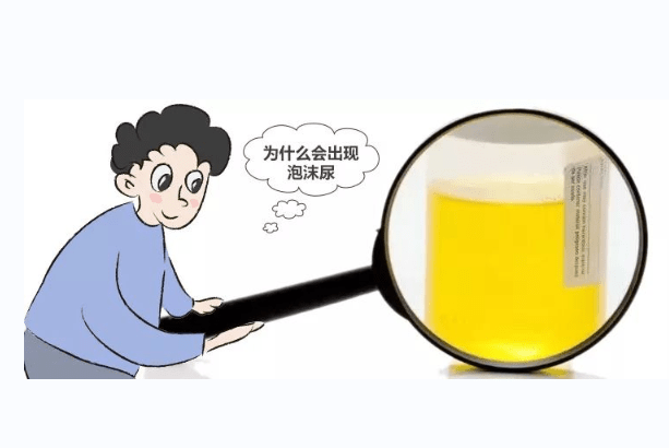 "泡沫尿"提示肾病?碰到这4种情况,或许不用太紧张!_尿液