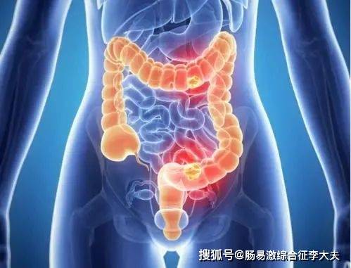 肠易激综合征专家李沛岭:比便秘还可怕的,是大便不成形!