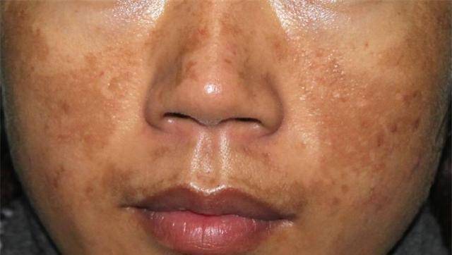 45岁女子脸上色素沉着,半年后干干净净,医生:方法或可