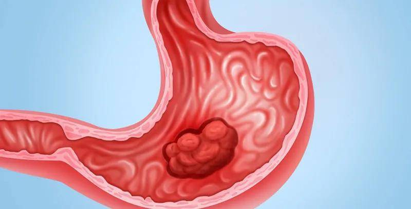 胃癌,胃炎,傻傻分不清楚?别慌,可以从这些方面入手