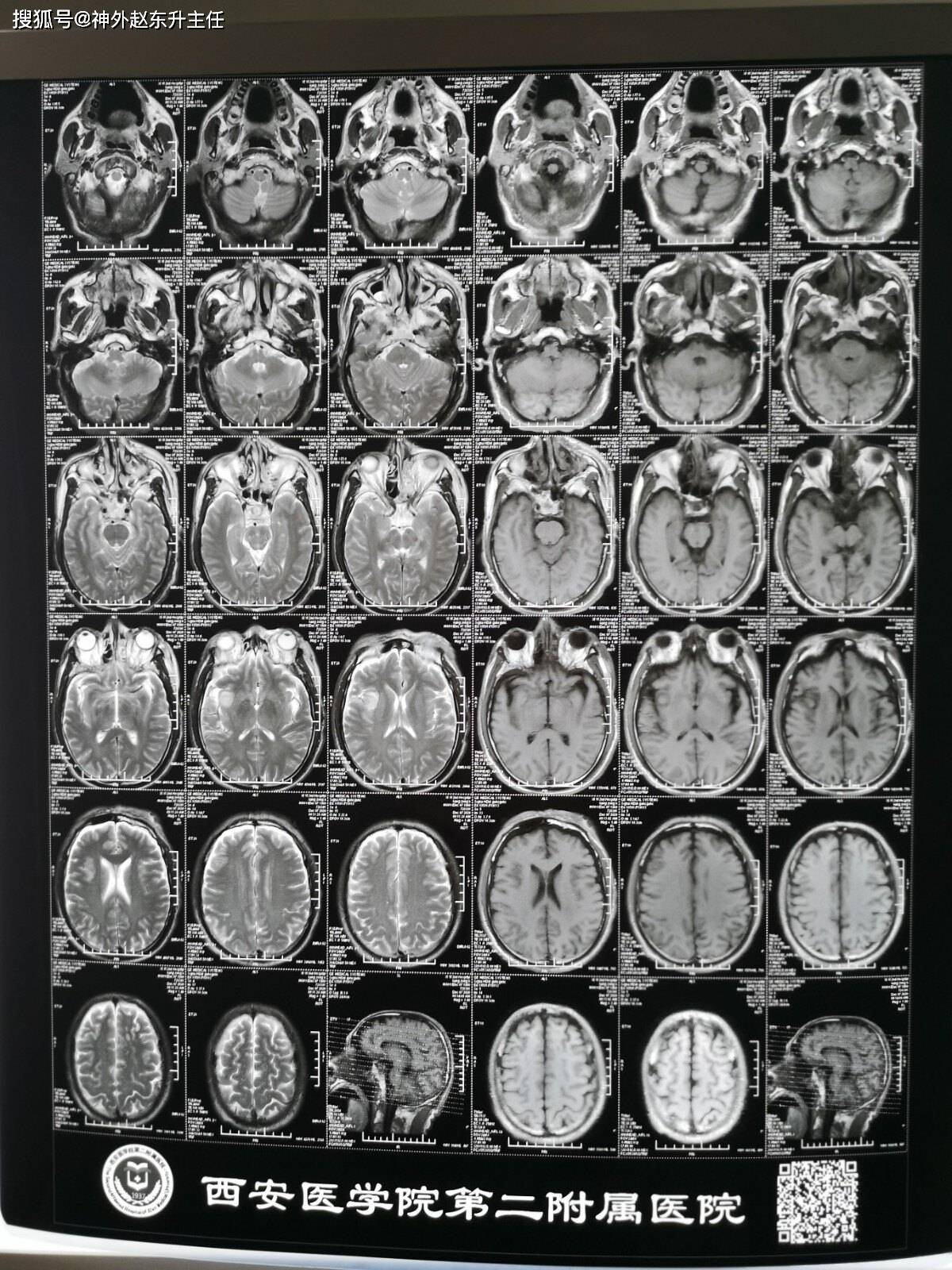 看片子好像伤的不太重啊,右颞叶一点小挫伤,怎么患者昏迷程度那么深呢