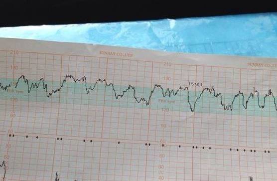 原创看不懂胎心监护图?二胎宝妈:记住2个关键数据,就明白了!