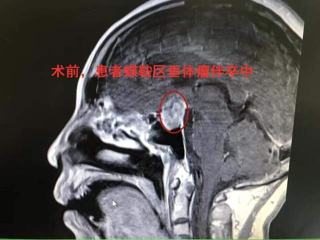 老年人视力陡降 元凶竟是垂体瘤卒中