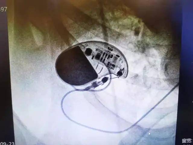 太原市中心医院心内科为79岁患者行第6次永久性心脏起搏器更换术