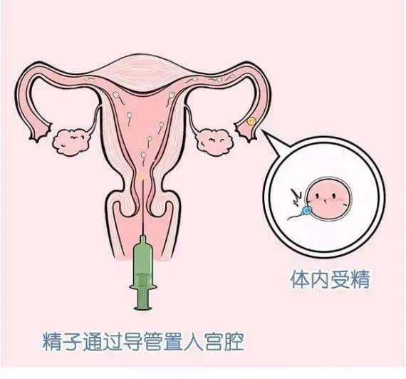 和体外人工受精不同,人工授精发生在女方生殖系统内,人工需要干预的