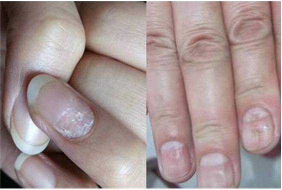 手指甲凹凸不平,出现"竖纹"?可能和这4个原因有关,别自己乱猜了!