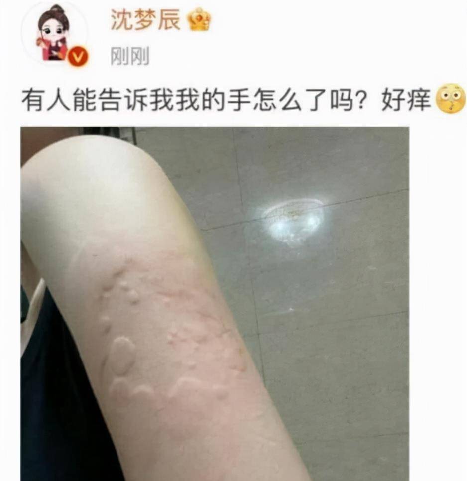 沈梦辰凌晨线上求医,手臂上起了大片疙瘩,粉丝们直呼好心疼