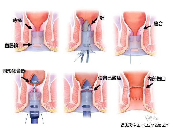 其实是在肛门附近的血管,因血液循环不良产生的静脉曲张