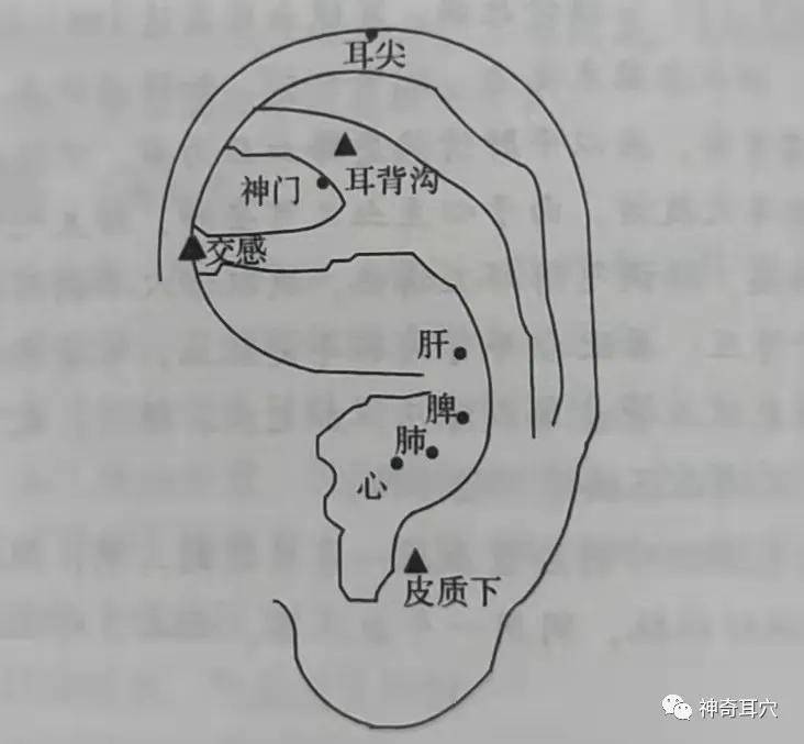 (1)耳穴:心,肝,脾,肺,神门,交感,皮质下,耳背沟,耳尖(放血).