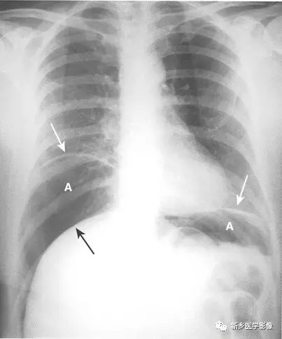 3个征象辨识腹腔游离气体