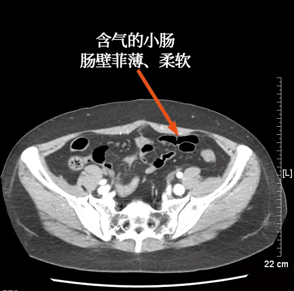 认识正常肠管与肠系膜,是发现异常征像的基础解剖基础ct 是诊断肠道与