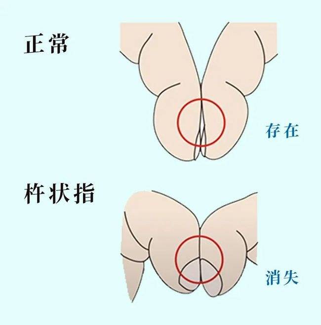 体内有病手指先知手指出现5种特征要排除疾病或癌的可能