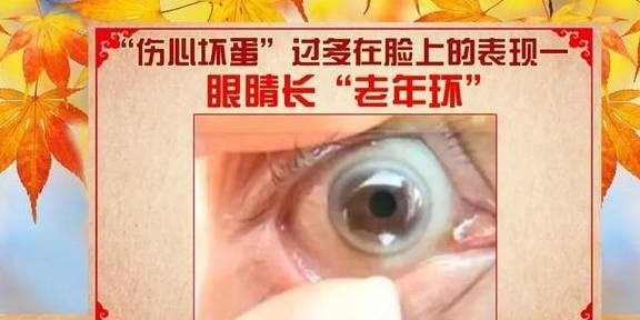 专家告诉我们:黑眼球周围有一圈灰白色的"老年环,眼睑上有黄色瘤