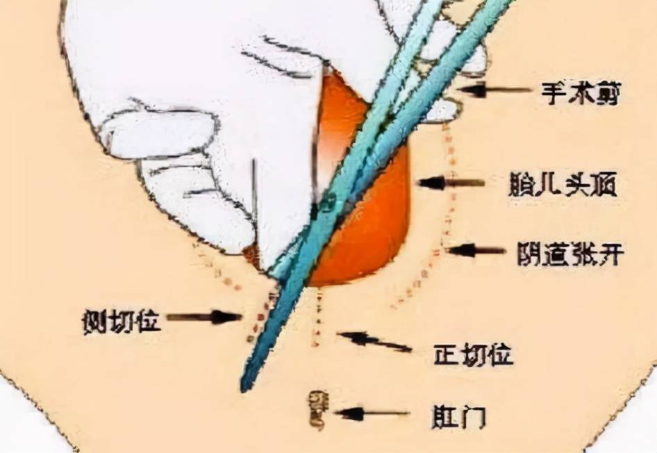 顺产被侧切,很多产妇对缝针印象深刻,疼不疼听听过来人怎么说